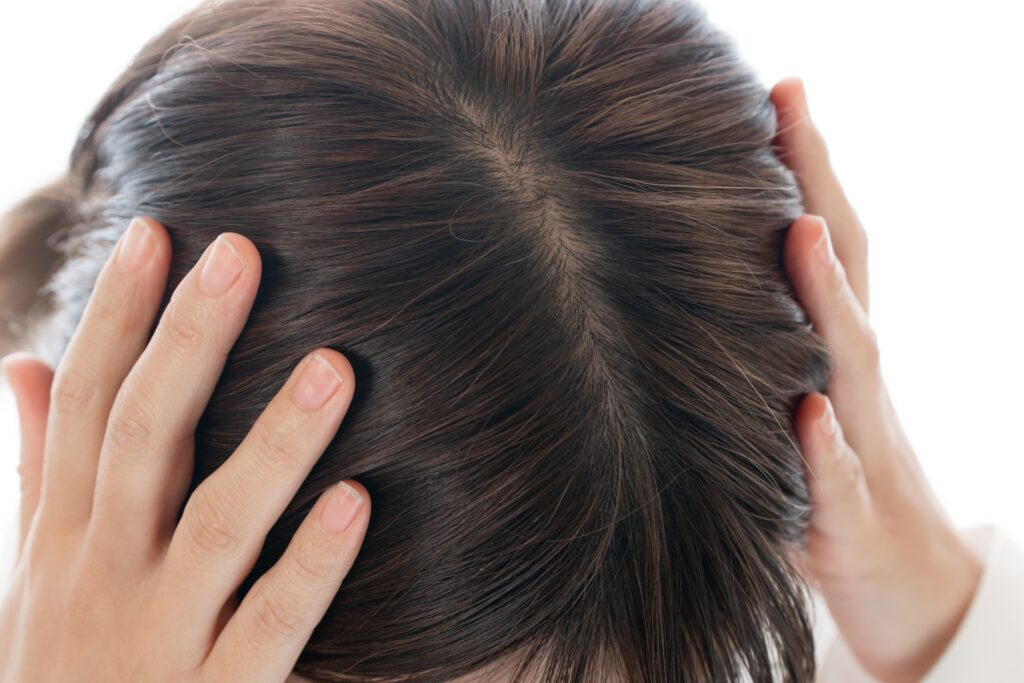 つむじの状態でわかる女性の薄毛の見分け方