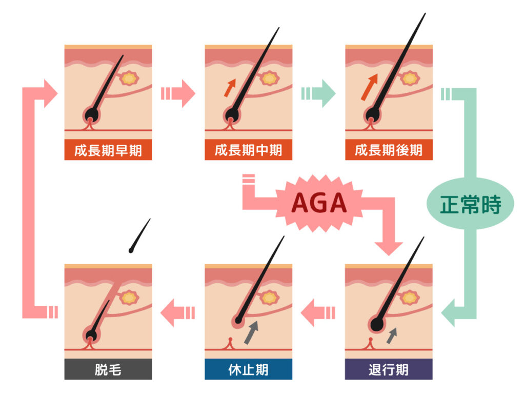 AGAの原因・メカニズムとは?