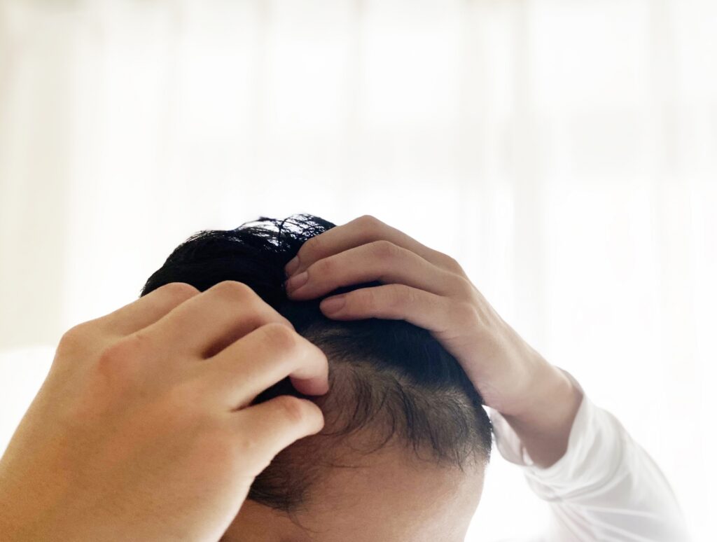 AGA治療は一生続けるべき?辞めることはできる?