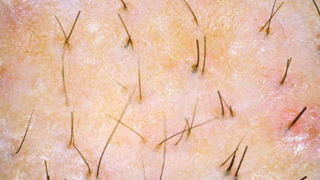 正常な抜け毛と異常な抜け毛(ひどい抜け毛)の見分け方