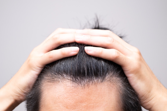 AGAはどの段階で「手遅れ」と言われるのか