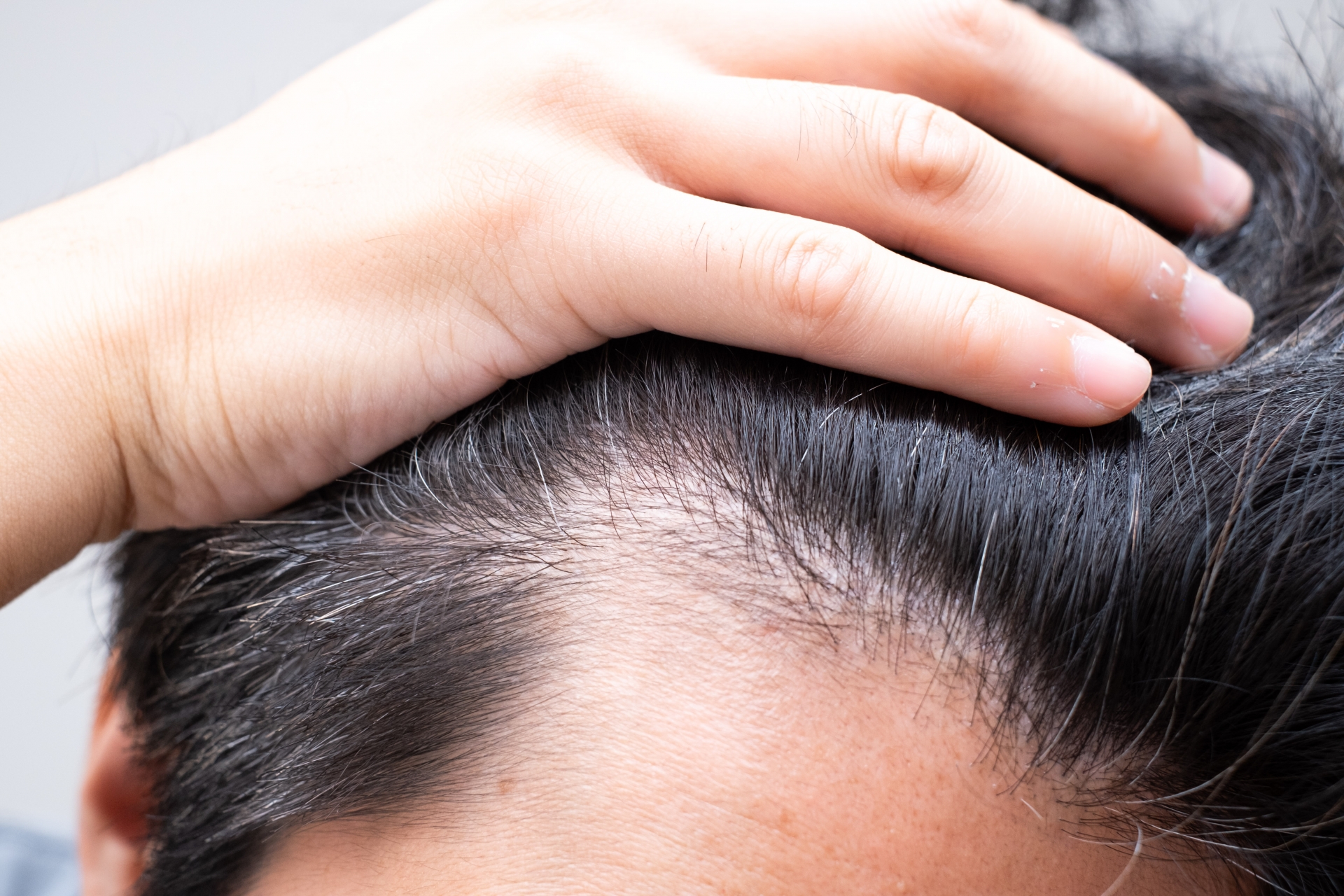 AGAは手遅れになる？今からでも間に合う治療法と見分け方を解説