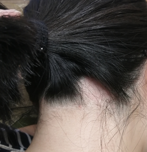 円形脱毛症は「内臓の病気で起きる」とは限らない