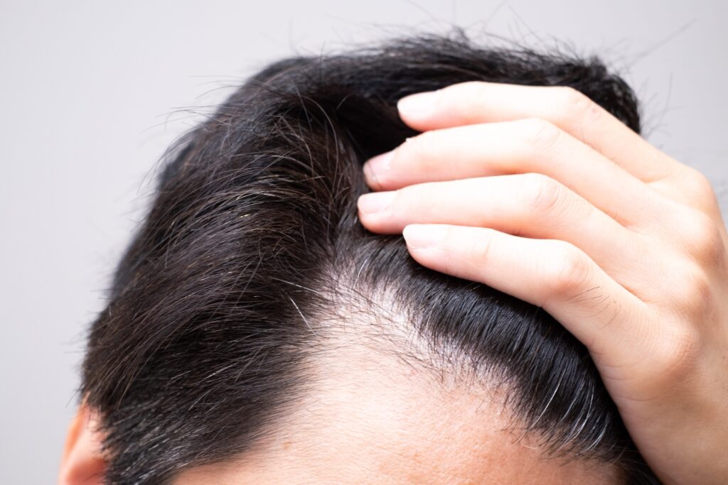 ミノキシジルによって生え際が生えるメカニズムについて