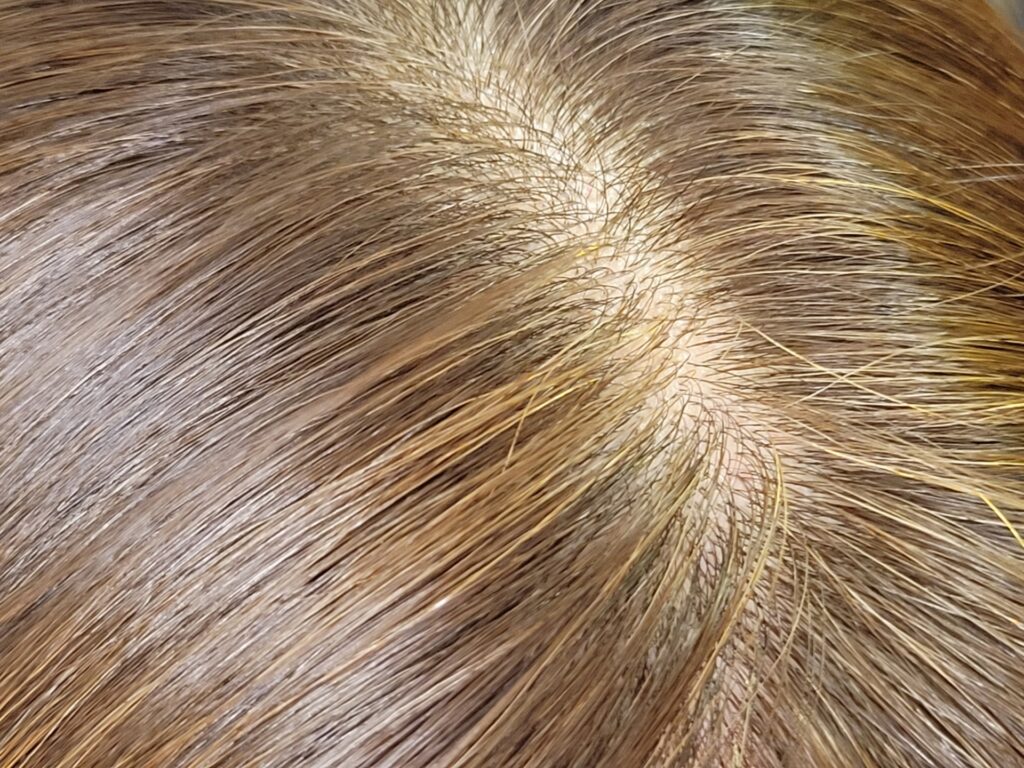 大きいフケが大量に出る時の正しい対処法