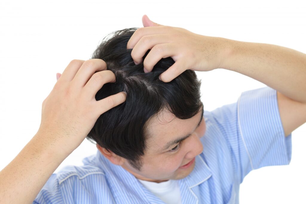 大きいフケが大量に出る主な原因