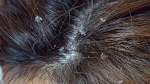 大きいフケが大量に出る原因とは？危険な症状・病気の可能性と正しい対処法