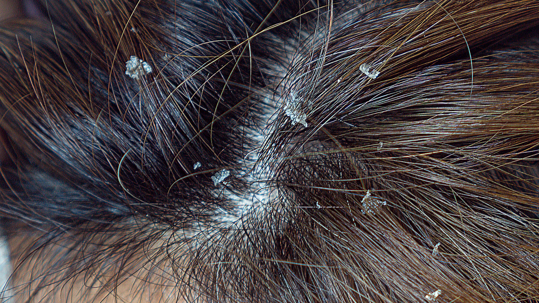 大きいフケが大量に出る原因とは？危険な症状・病気の可能性と正しい対処法